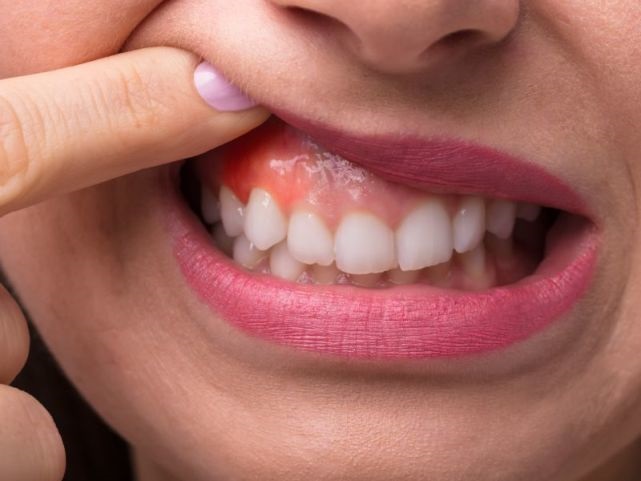 Tips I 食物经常塞牙缝？可能跟这5种口腔病有关 更多热点 图1张