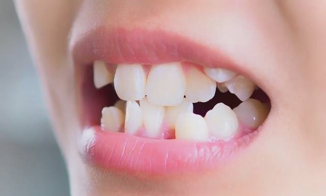 Tips I 食物经常塞牙缝？可能跟这5种口腔病有关 更多热点 图5张