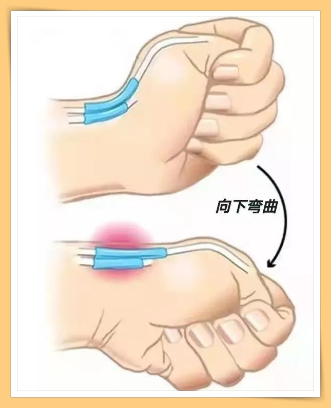 Tips I 长时间玩手机小心患上腱鞘炎！这4个方法可防治“手机手”！ 更多热点 图3张
