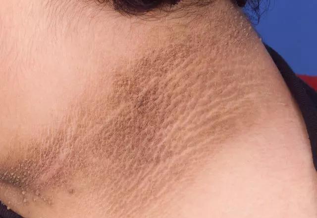 健康 I 脖子后面黑黑不是脏而是病！患上黑棘皮症的3大原因 更多热点 图1张