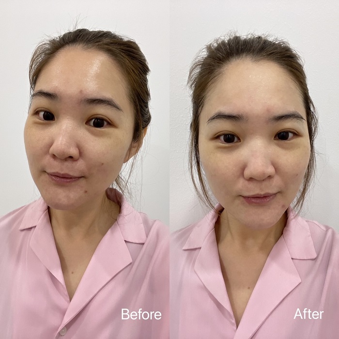 【美编体验报告】长痘不可怕最怕留痘印！Discovery Pico 探索皮秒劈劈啪啪搞定它们 更多热点 图7张