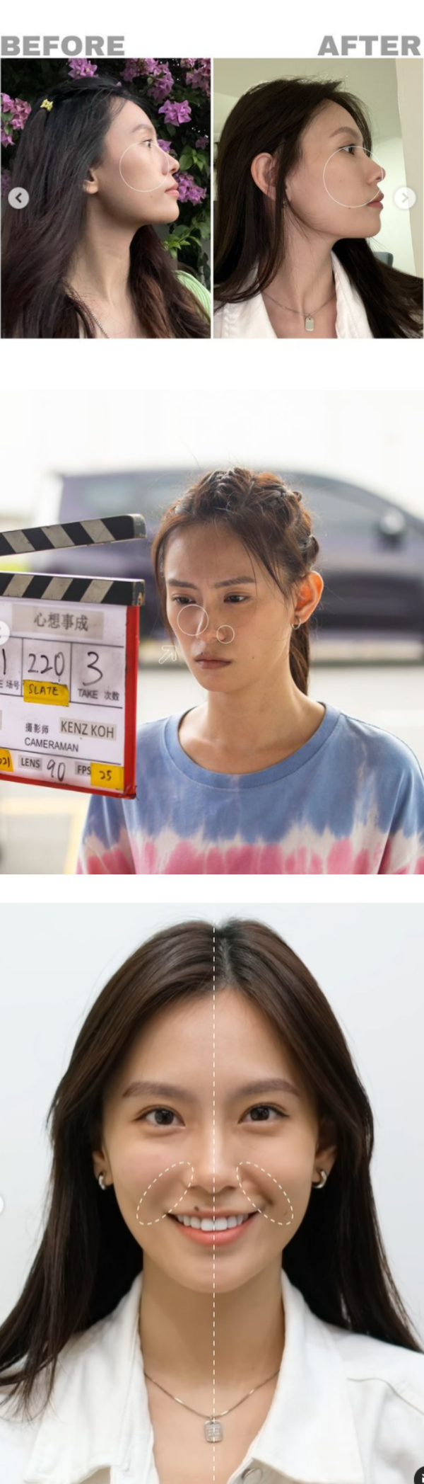 美姐季军恺欣公开微整经验！填苹果肌+鼻基底...晒前后对比图 娱乐资讯 图2张