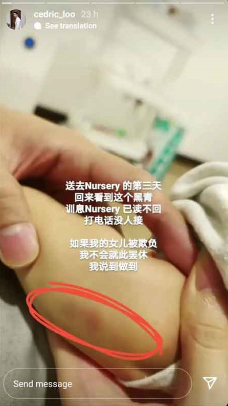 8月大女儿幼儿园回家后 手脚惊现不明瘀伤！吕锐担心女儿被欺负 娱乐资讯 图1张