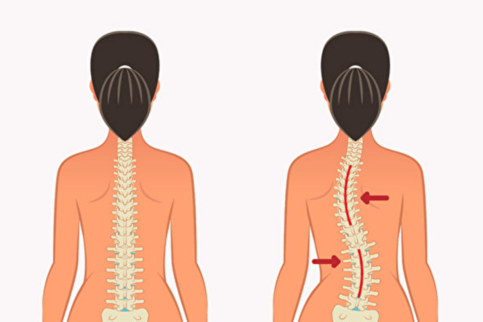 生活｜每个人都会脊椎侧弯？关于侧弯的6大迷思，过度健身也是主因？ 更多热点 图2张
