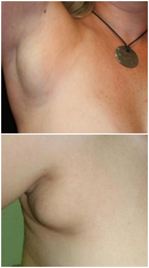 生活｜副乳也会有乳腺癌？出现这3种情况女生们可要注意了！ 更多热点 图2张