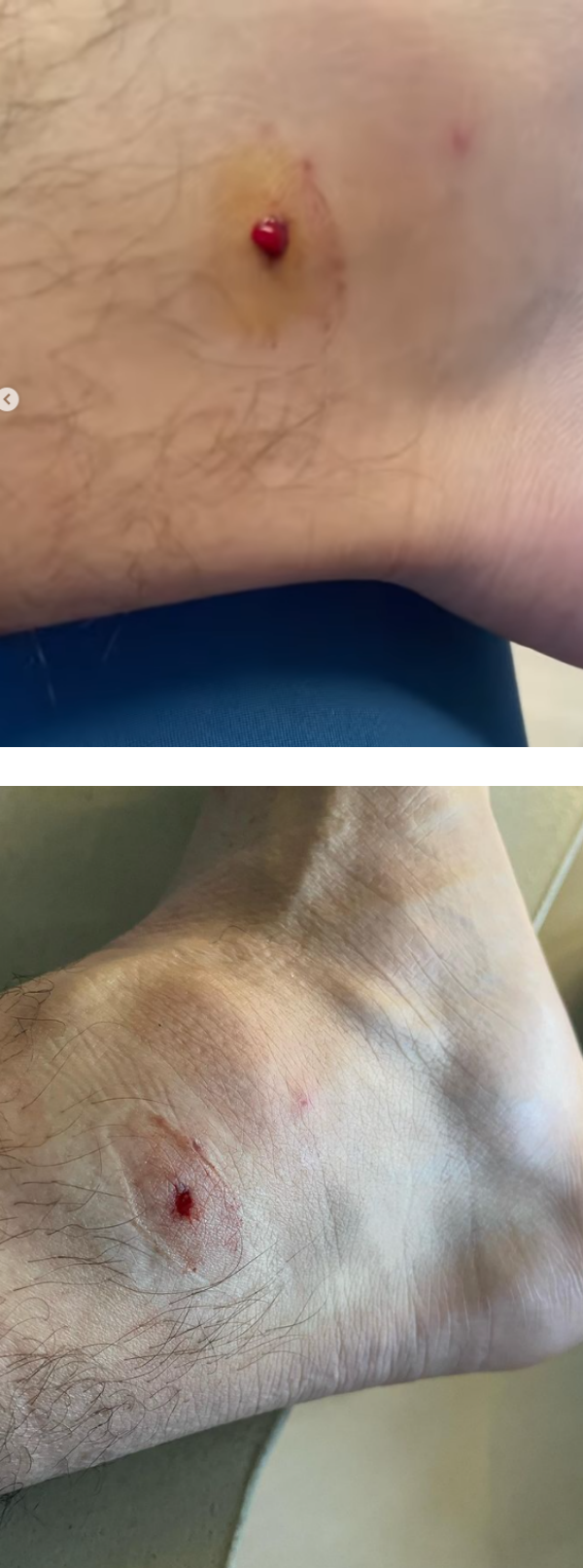 钉鞋插进肉里...脚踝伤口不停冒血！贺军翔哭喊：超级痛 娱乐资讯 图1张