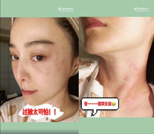 赴韩拍戏不适应？范冰冰首次出现“皮肤严重过敏”：好可怕 娱乐资讯 图1张