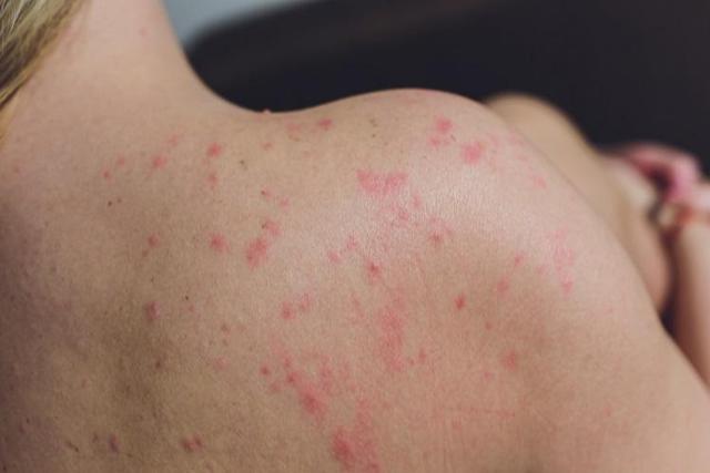 Tips I 荨麻疹过敏找不到原因？难道是水杨酸食物导致 更多热点 图1张