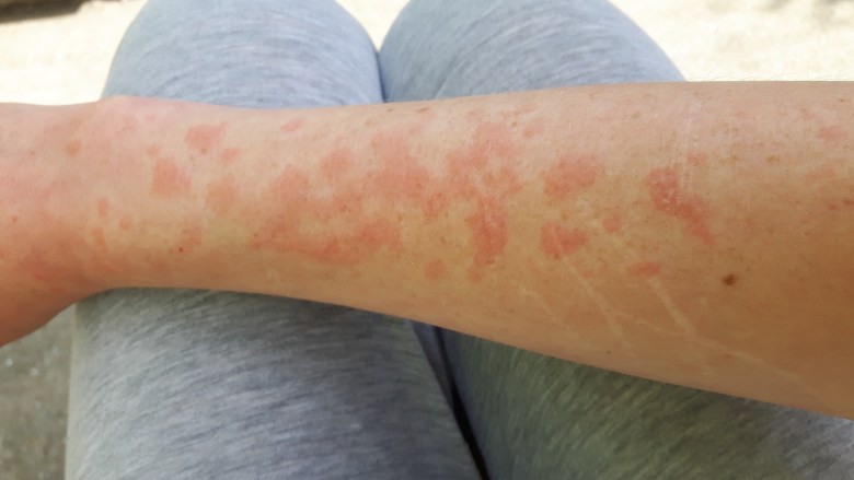 Tips I 荨麻疹过敏找不到原因？难道是水杨酸食物导致 更多热点 图5张