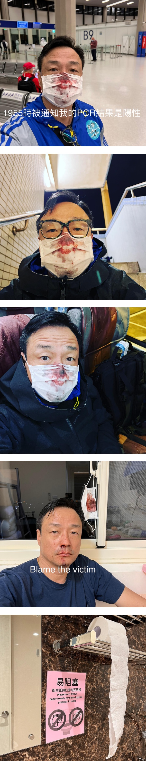 王喜入境中国台湾做PCR被捅伤…鼻孔鲜血狂喷！气到直接报警 娱乐资讯 图3张