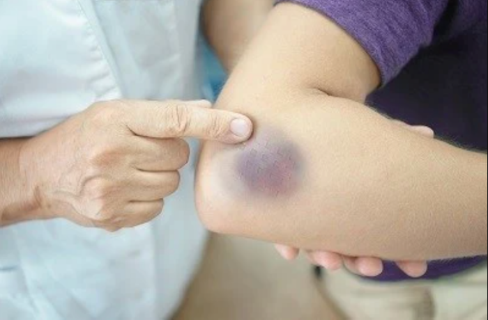 生活｜揉黑青=爆血管？用蛋热敷、大力揉除瘀青都是错？ 更多热点 图1张