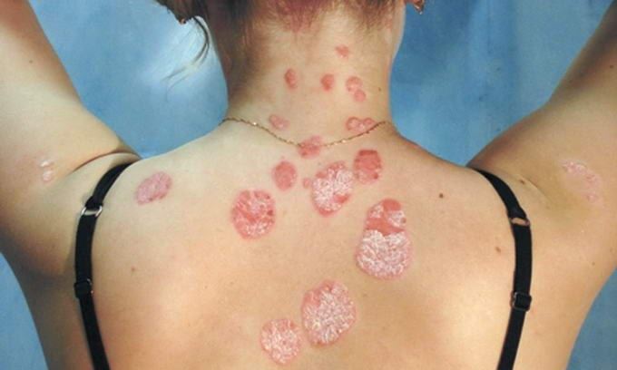 健康 I 李施嬅患上的自体免疫性疾病到底是什么？女性患病比男性高一倍！ 更多热点 图4张