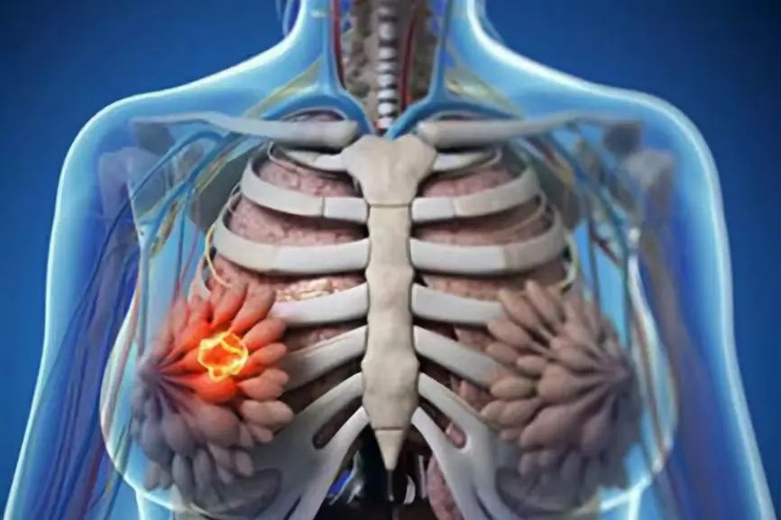 健康 I 肥胖竟会致癌？6种最爱找上胖子的癌症 更多热点 图4张
