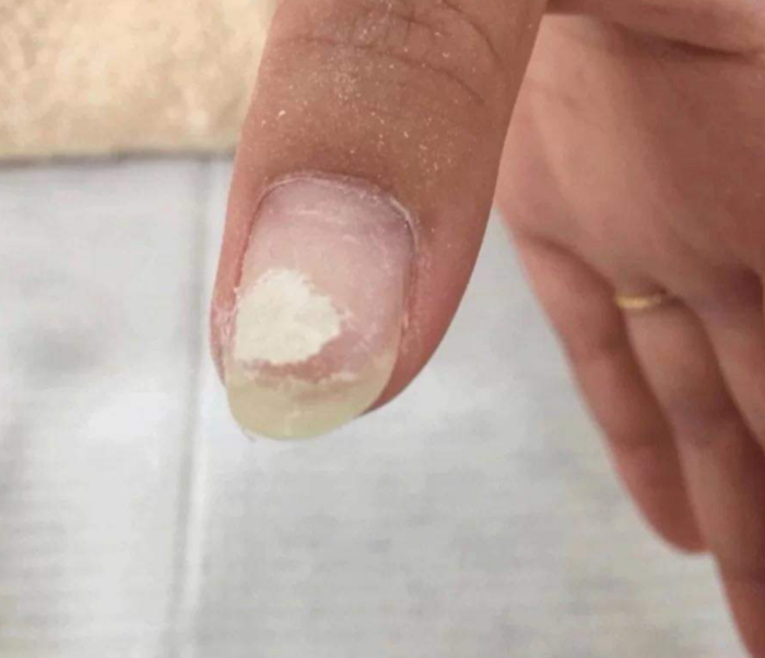 健康｜指甲出现分层是怎么一回事？爱运动的人也常中招？ 更多热点 图2张