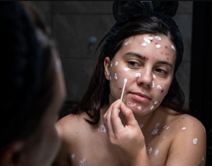 科普 ｜为何水痘要叫Chickenpox，难道真的和鸡有关系？ 更多热点 图1张