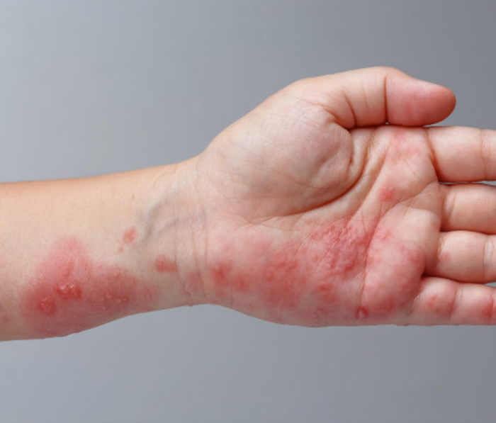科普 ｜为何水痘要叫Chickenpox，难道真的和鸡有关系？ 更多热点 图3张