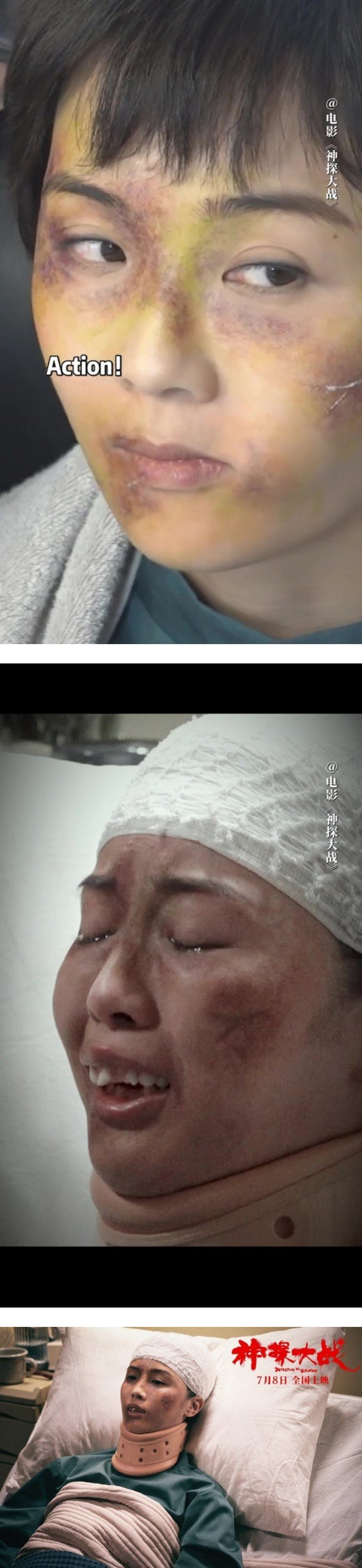 阿Sa惊悚毁容样曝光！ 全脸淤血+疤痕...粉丝都认不出 娱乐资讯 图2张