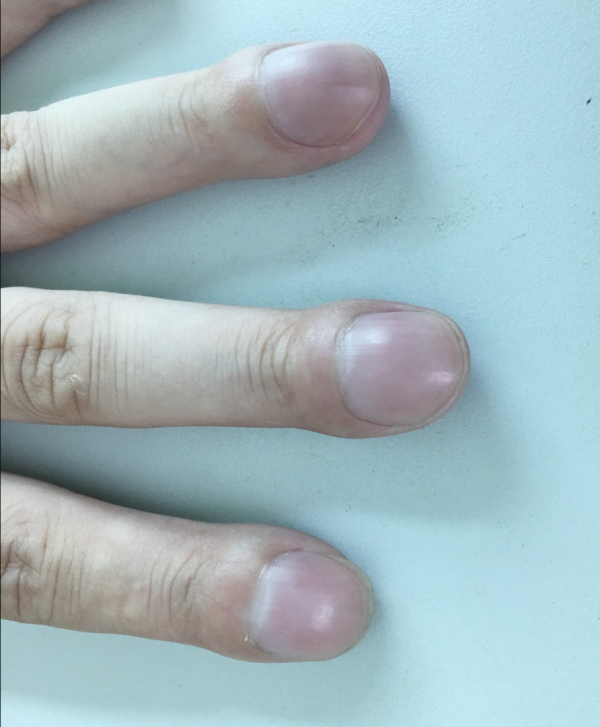 健康｜长期干咳以为小事？小心其实是肺部正在纤维化 更多热点 图3张
