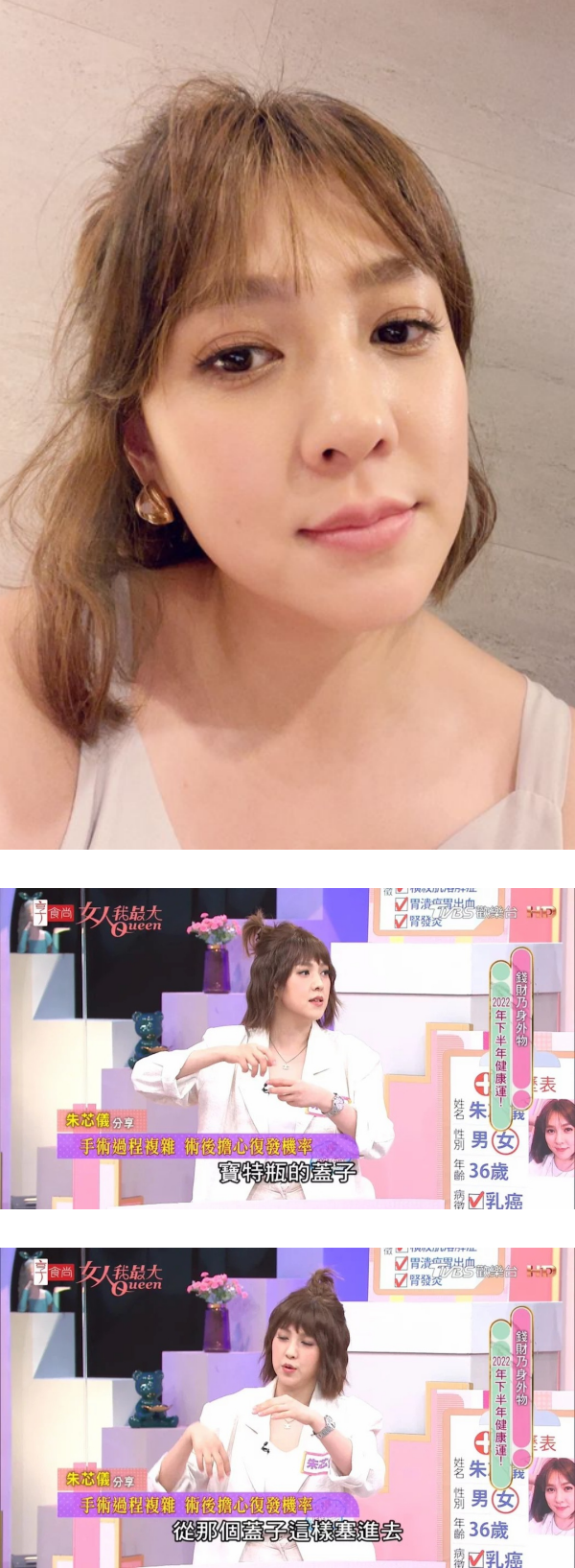 “切除乳头、乳晕”保命！36岁朱芯仪曝超长伤口：比剖腹产还大 娱乐资讯 图1张