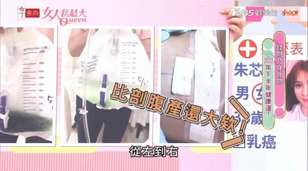 “切除乳头、乳晕”保命！36岁朱芯仪曝超长伤口：比剖腹产还大 娱乐资讯 图2张