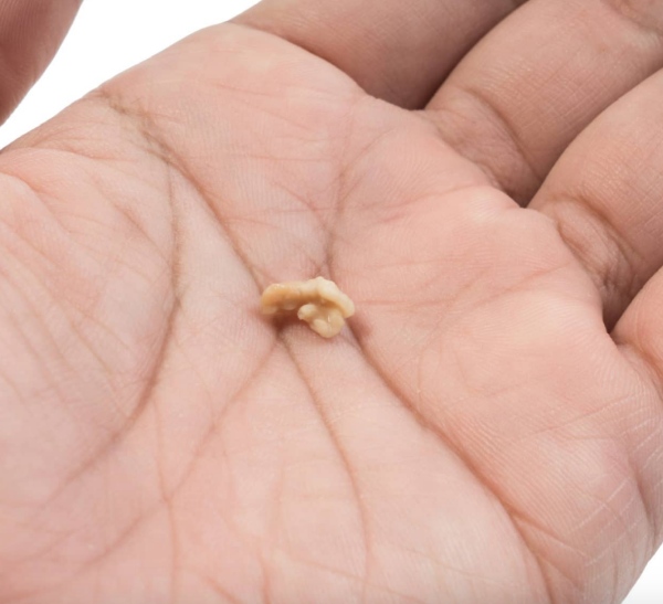 Tips I 口臭的祸首！小小白色的扁桃体结石到底是什么？ 更多热点 图3张