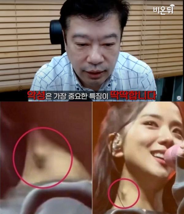BLACKPINK Jisoo 淋巴结肿大！医生曝：99.99%有问题…建议马上去医院检查！ 娱乐资讯 图2张