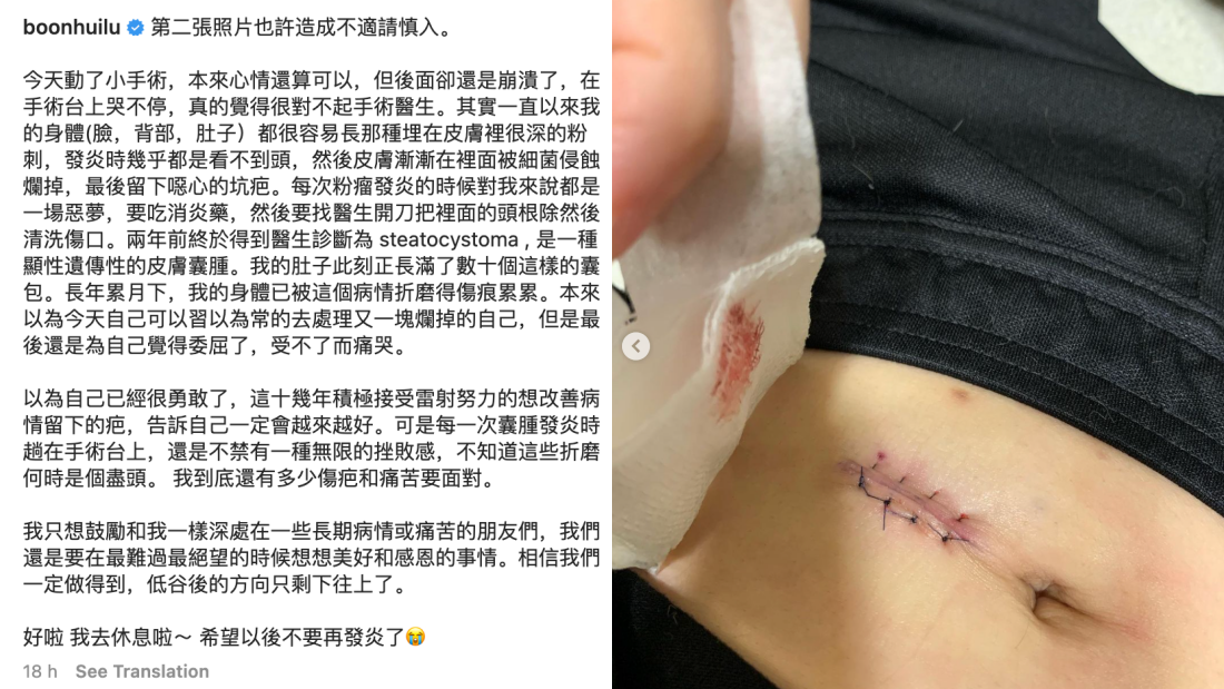 文慧如肚子长满“囊包”！手术后泪诉：到底还有多少痛苦要面对 娱乐资讯 图2张