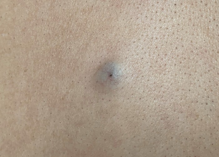 健康I 误会是超大颗暗疮，其实是粉瘤！严重还需要动手术？ 更多热点 图2张