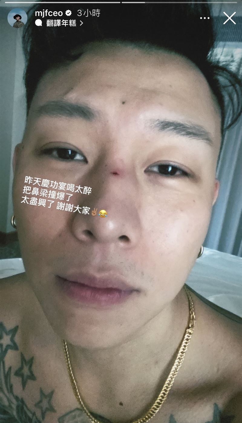 庆功喝醉“撞伤鼻梁破相”首现身！瘦子帅度不减“还原溅血经过” 时尚资讯 图2张