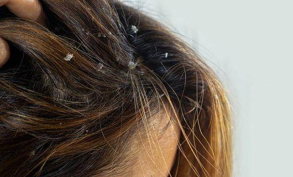 夏季出油、头皮屑有解！“好好洗头、做好清洁”最重要 最新资讯 图1张