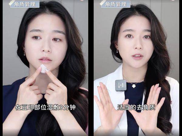 痘疤比痘痘更难搞！皮肤科医师教“正确去痘印”护理4重点 最新资讯 图2张