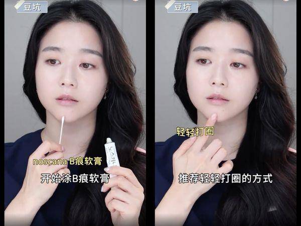 痘疤比痘痘更难搞！皮肤科医师教“正确去痘印”护理4重点 最新资讯 图5张
