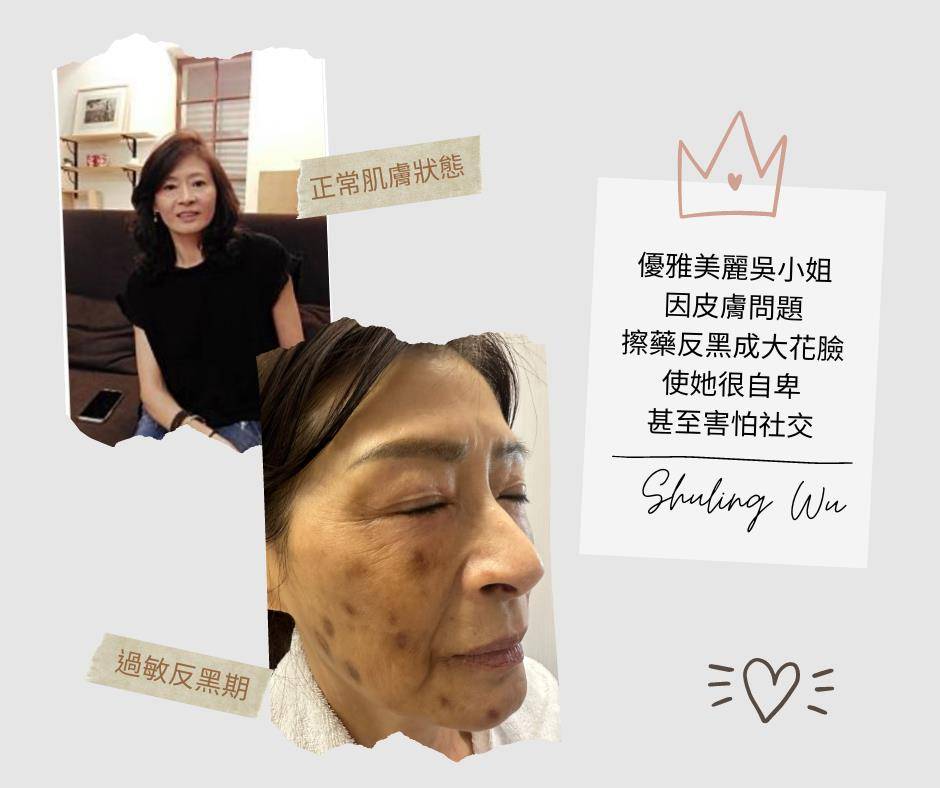 拯救烂脸变嫩脸！潮正奢REGAL水光奇迹　4个月逆转肌肤重拾自信 最新资讯 图2张
