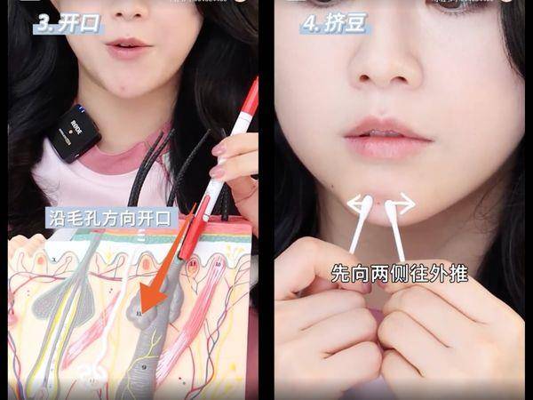 皮肤科医师教“正确挤痘法”不留痘印！　挤的方向很重要 最新资讯 图4张