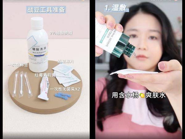 皮肤科医师教“正确挤痘法”不留痘印！　挤的方向很重要 最新资讯 图2张