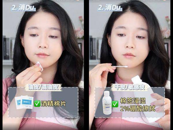 皮肤科医师教“正确挤痘法”不留痘印！　挤的方向很重要 最新资讯 图3张