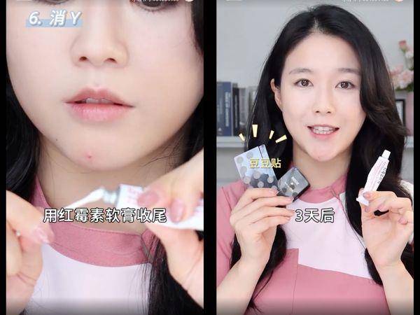 皮肤科医师教“正确挤痘法”不留痘印！　挤的方向很重要 最新资讯 图6张