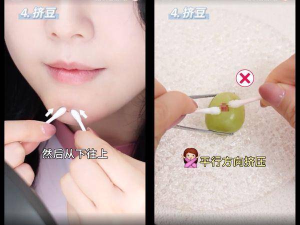 皮肤科医师教“正确挤痘法”不留痘印！　挤的方向很重要 最新资讯 图5张